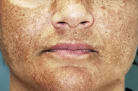 Melasma treatment and pigmentation removal by Dr. Vaishali Sapat